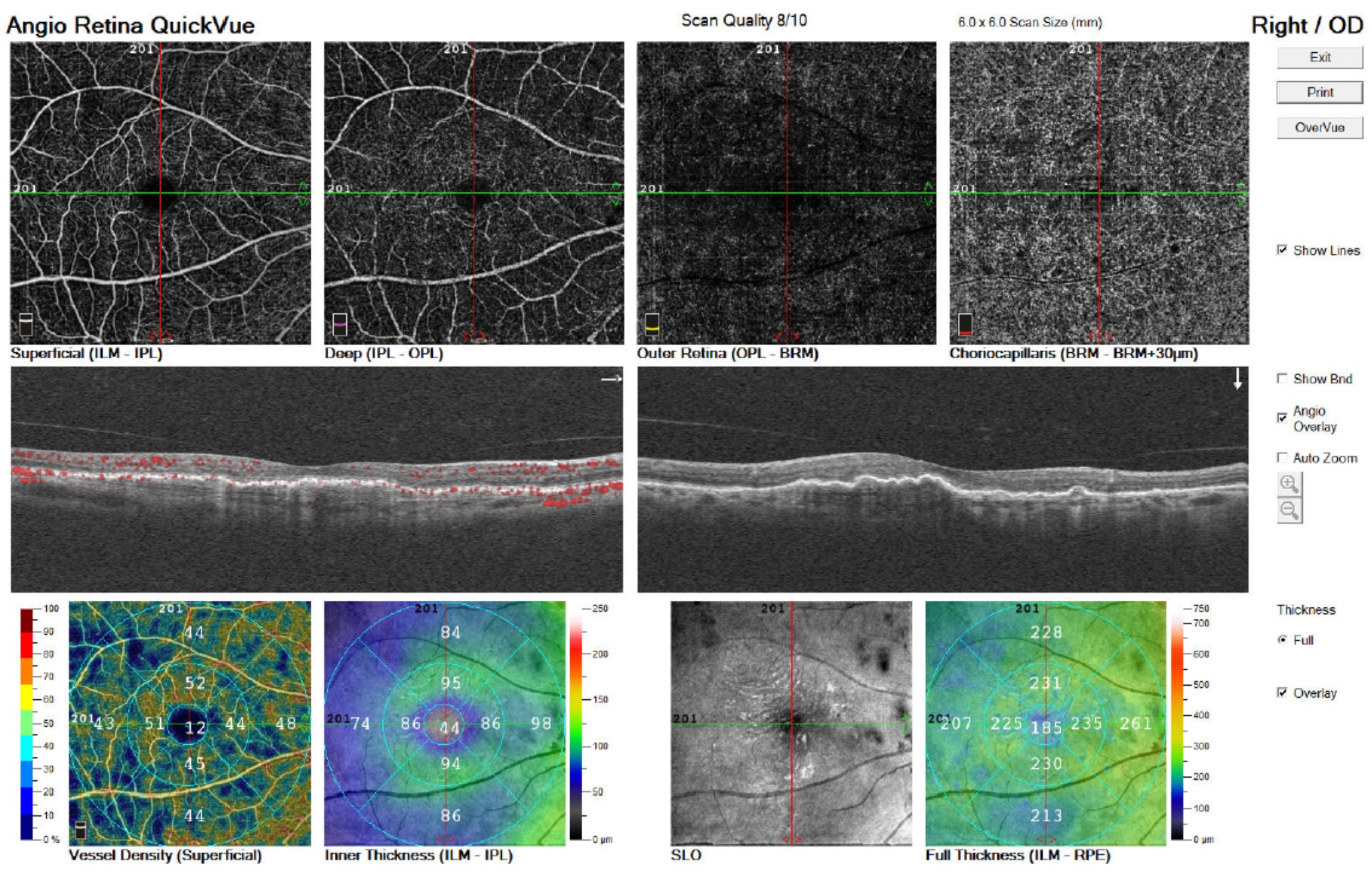 OCT de degeneración macular húmeda después del tratamiento intravítreo. Especialista en retina Santiago.