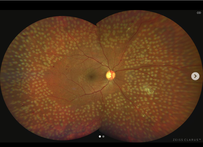 Imagen de seguimiento retinal — retinopatía diabética
